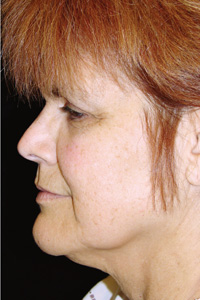 Case--4589 | Before Quick Lift